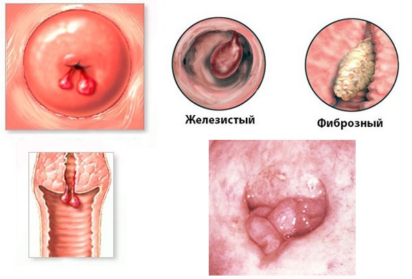 Причини виникнення поліпа цервікального каналу
