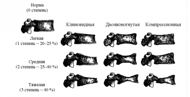 Як зрозуміти, що почався остеопороз при клімаксі