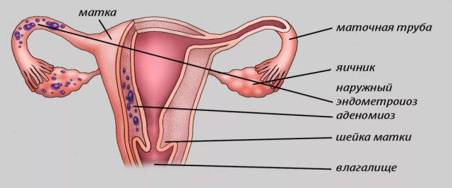 Як лікувати народними засобами аденоміоз матки