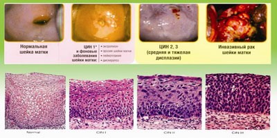 Прогноз при плоскоклеточном неороговевающего раку шийки матки