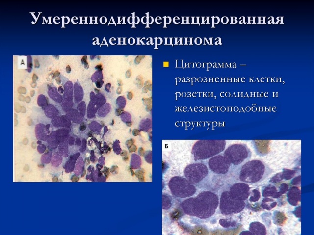 Помірно диференційована аденокарцинома матки