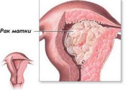 Хіміотерапія при раку шийки матки