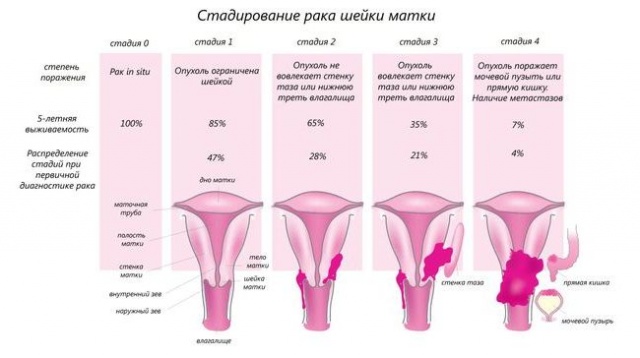 Тривалість життя при раку шийки матки