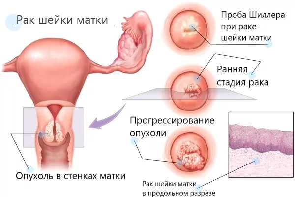 Тривалість життя при раку шийки матки