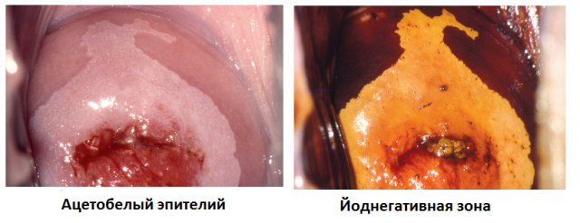 Розшифровка кольпоскопії шийки матки