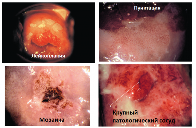 Розшифровка кольпоскопії шийки матки