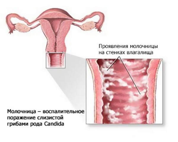 Кандістон і Епіген спрей від молочниці