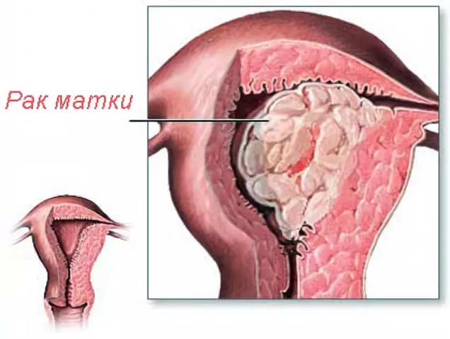 Лікування раку матки