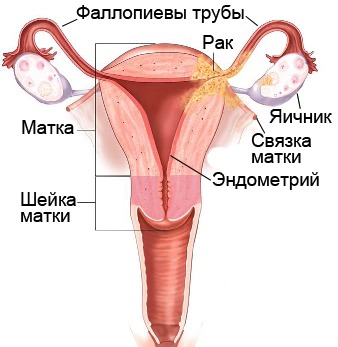 Лікування раку матки