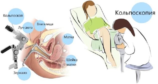 Чи можна робити кольпоскопію під час місячних