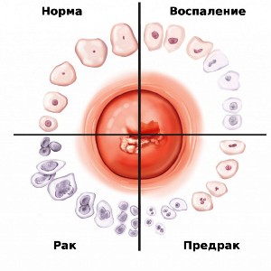 Виділення після кольпоскопії шийки матки