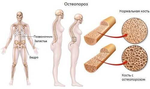 Чому болять суглоби при клімаксі