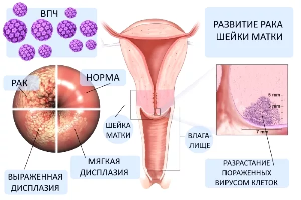 Аналіз біопсія шийки матки