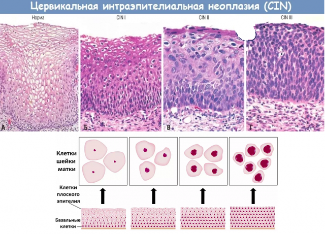 Аналіз біопсія шийки матки